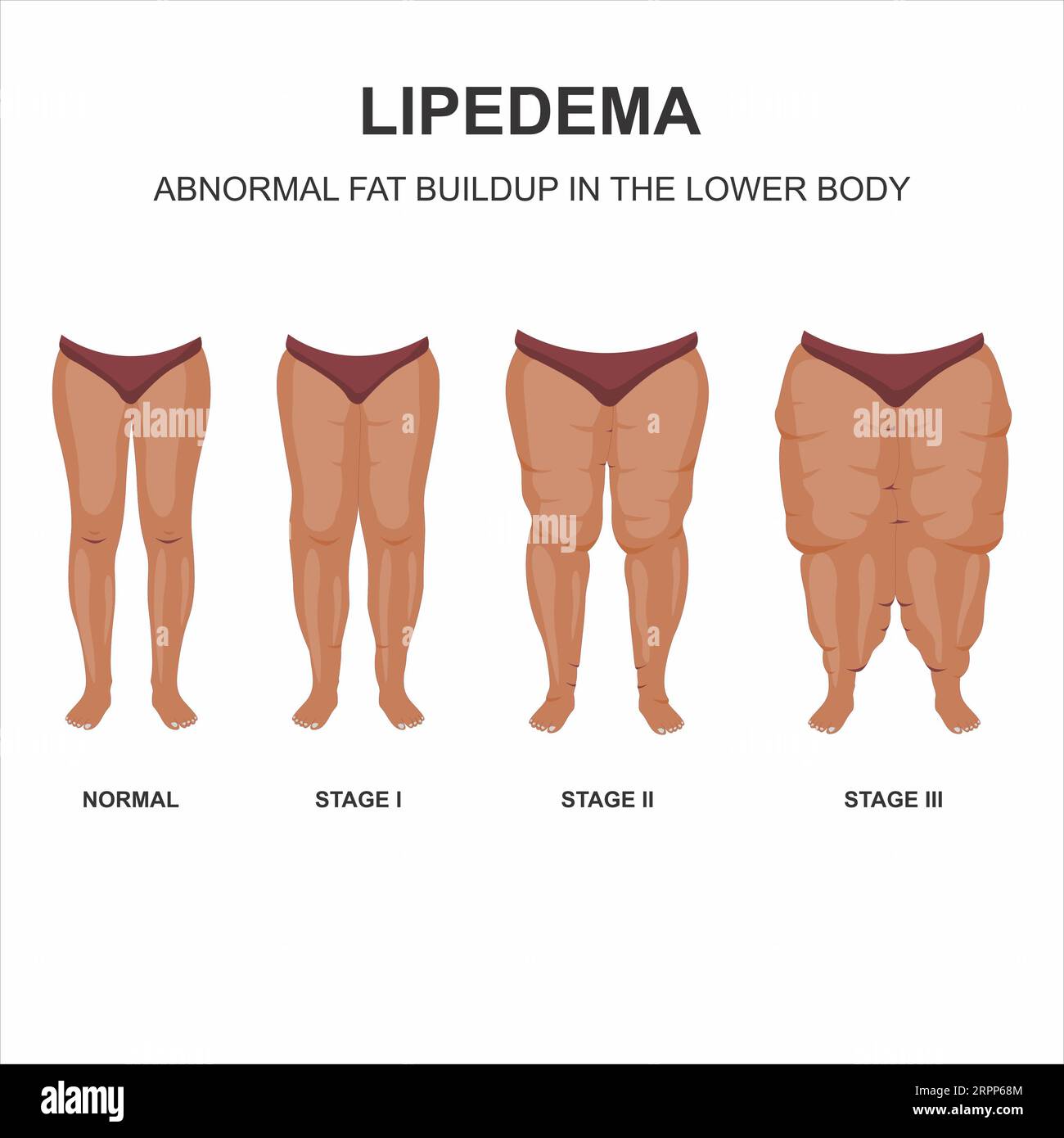 THE 4 STAGES OF LIPEDEMA-A CLOSER LOOK AT EACH ONE - Total