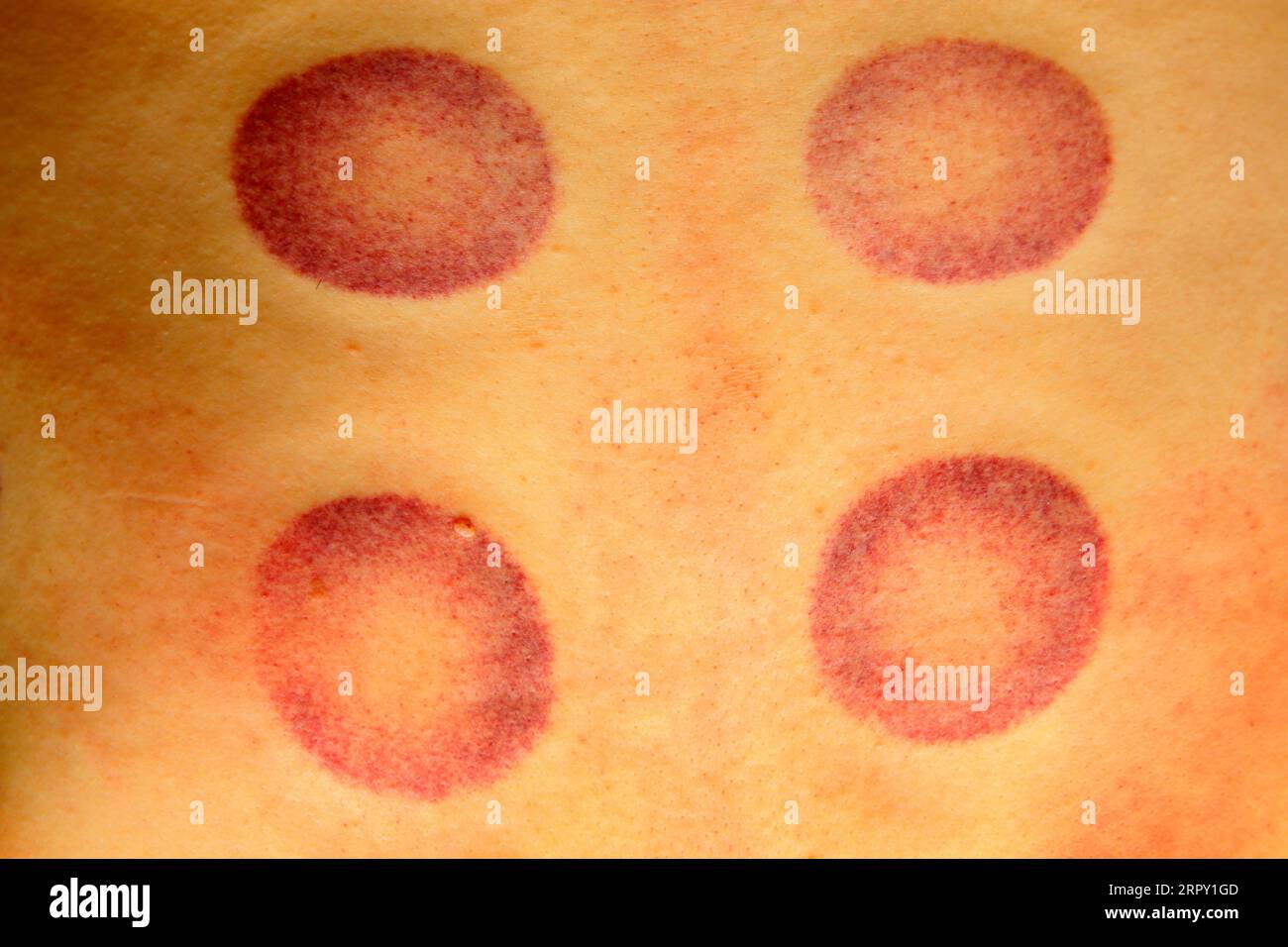 Picture of Erythema Multiforme Minor | Paw print tattoo, Skin diseases,  Disease