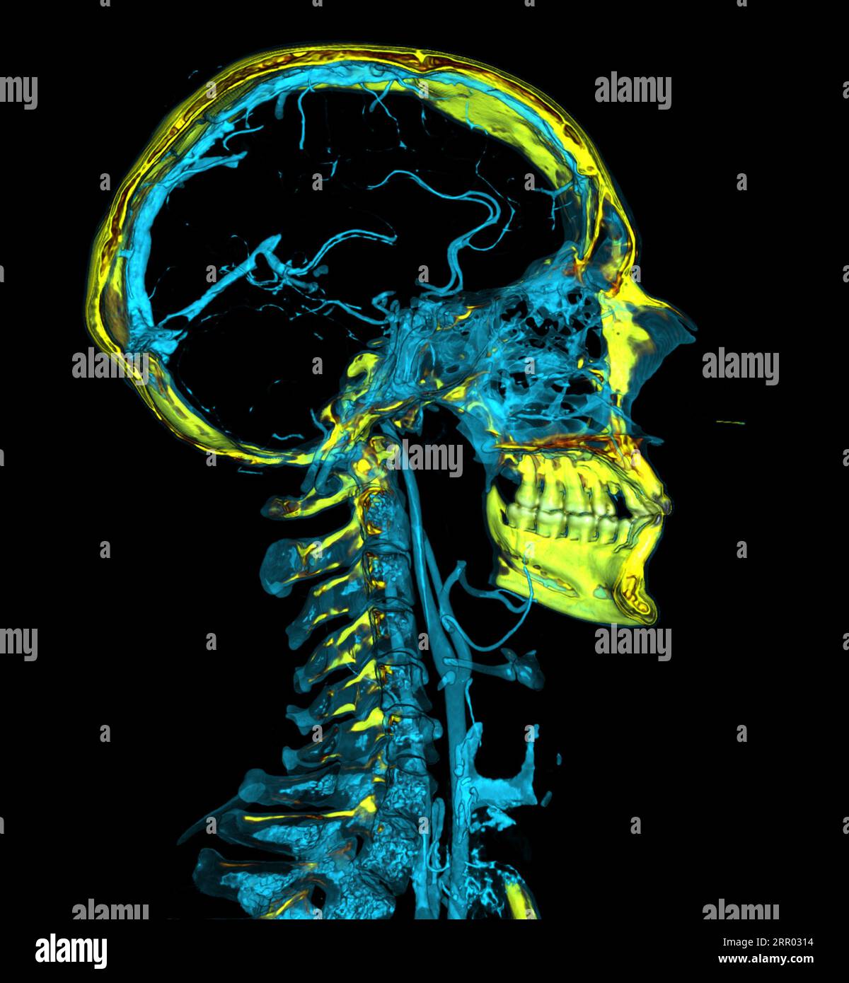 Head and neck blood vessels, CT scan Stock Photo - Alamy