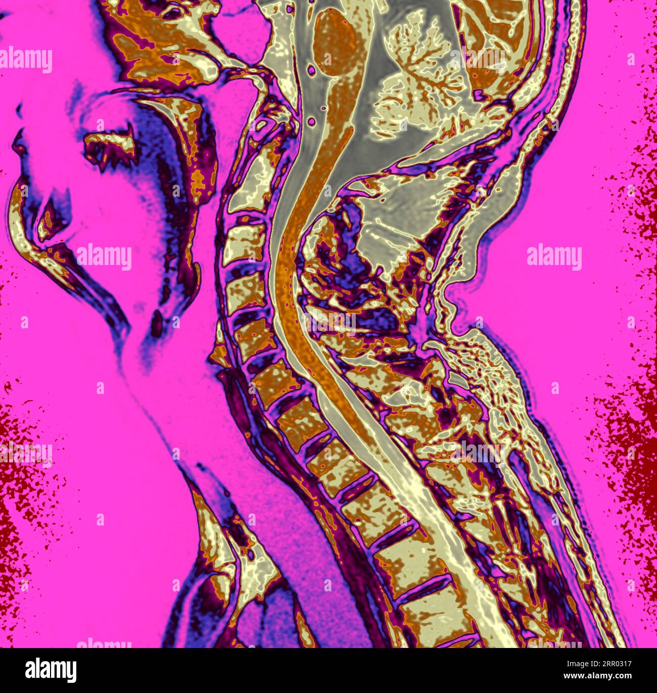 Slipped disc, MRI scan Stock Photo - Alamy