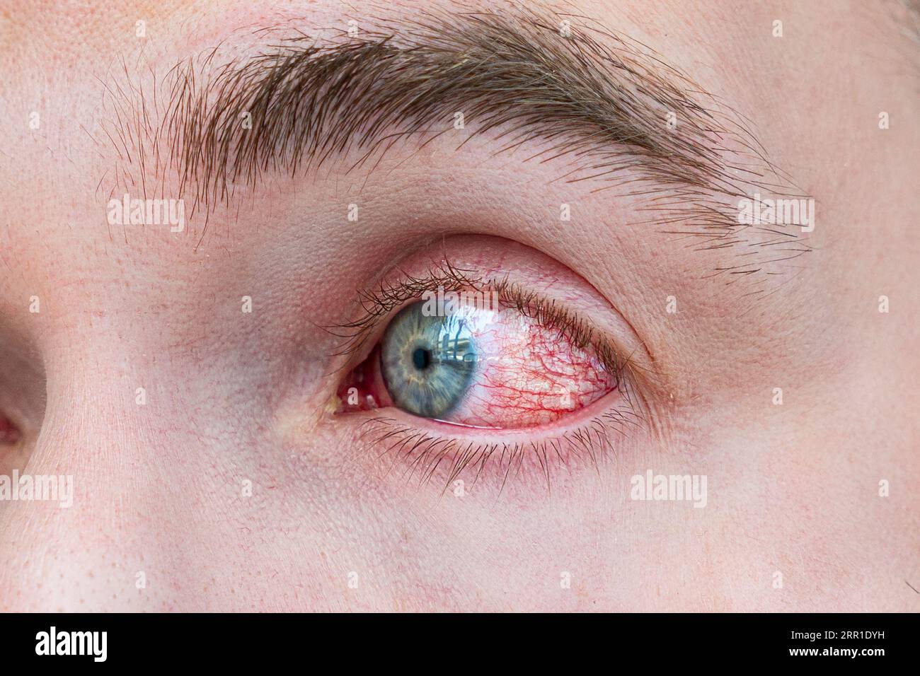 Man with red eye, macro shot. Conjunctivitis infection. The concept of eye disease, Allergic conjunctivitis hyperemia Stock Photo