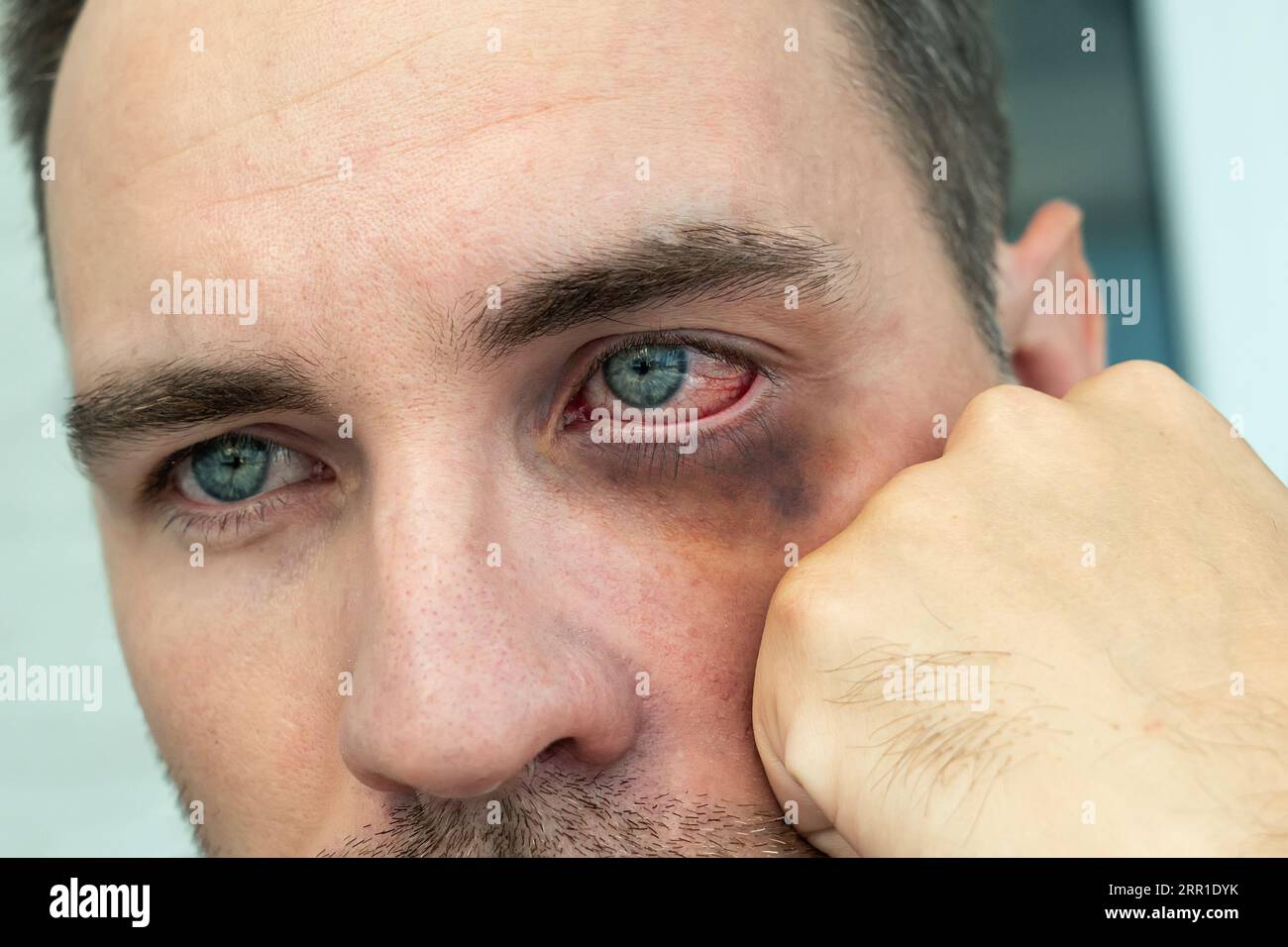 Bruises, abrasions, bruising under the eye of a young man. the consequences of punching a man in the eye concept. trauma to the face after a beating. Stock Photo