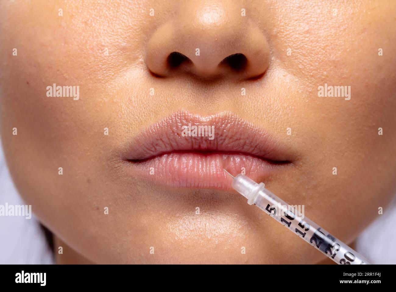Close up of the lips of asian woman having collagen filler injection Stock Photo