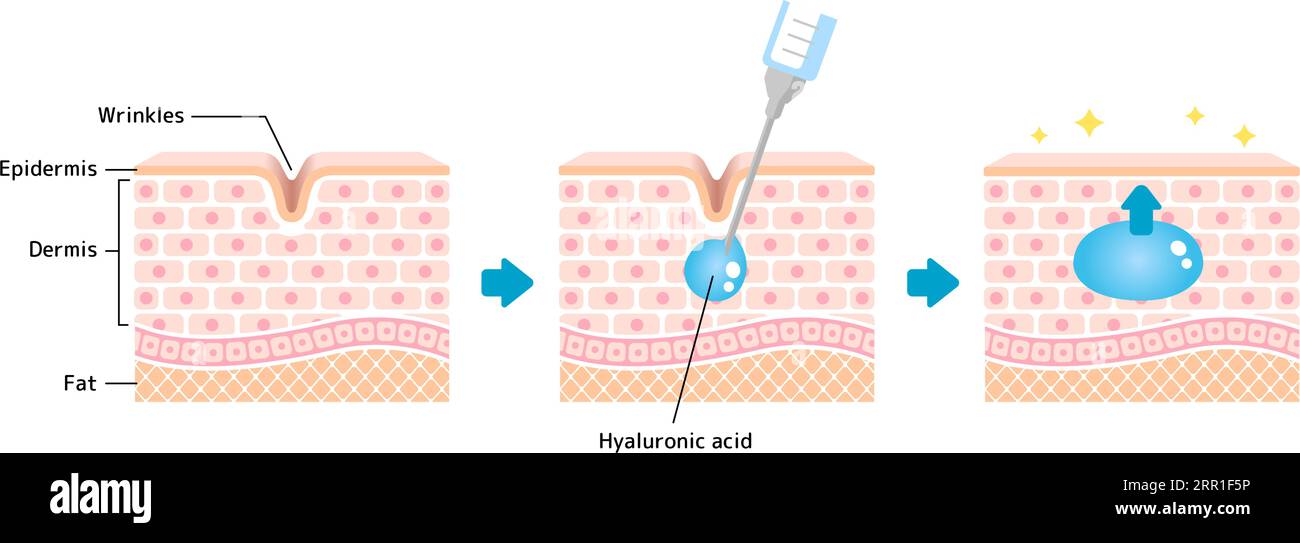 Mechanism illustration of hyaluronic acid injection (cross-sectional view of the skin) Stock Vector