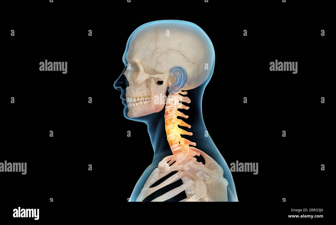 Side view of cervical section of spine injury and pain on black background Stock Photo