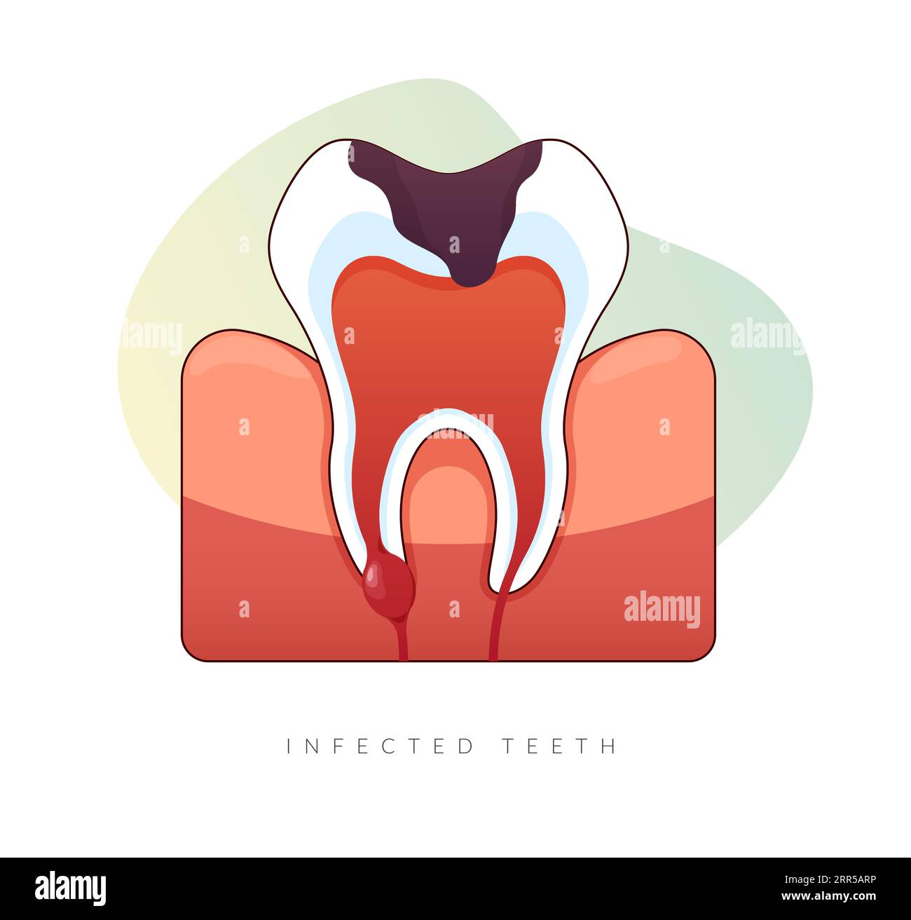 Infected Teeth Root Canal Treatment Stock Illustration as EPS 10