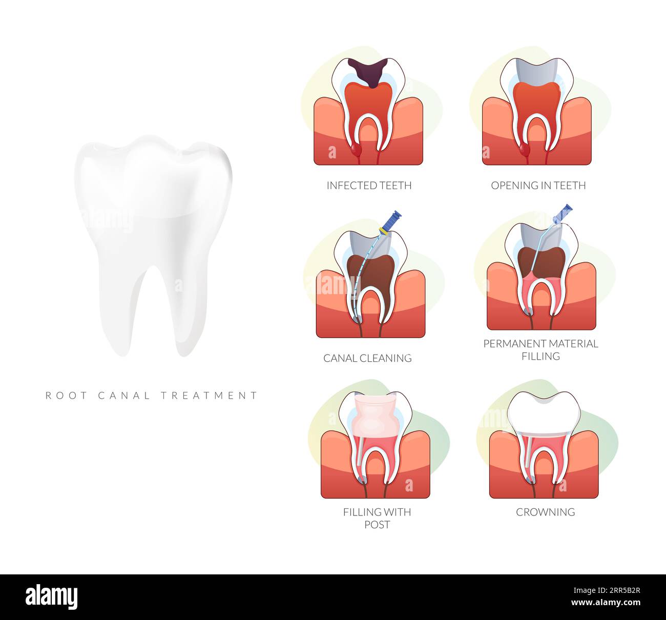 Dental Procedure Root Canal Treatment Stock Illustration as EPS 10