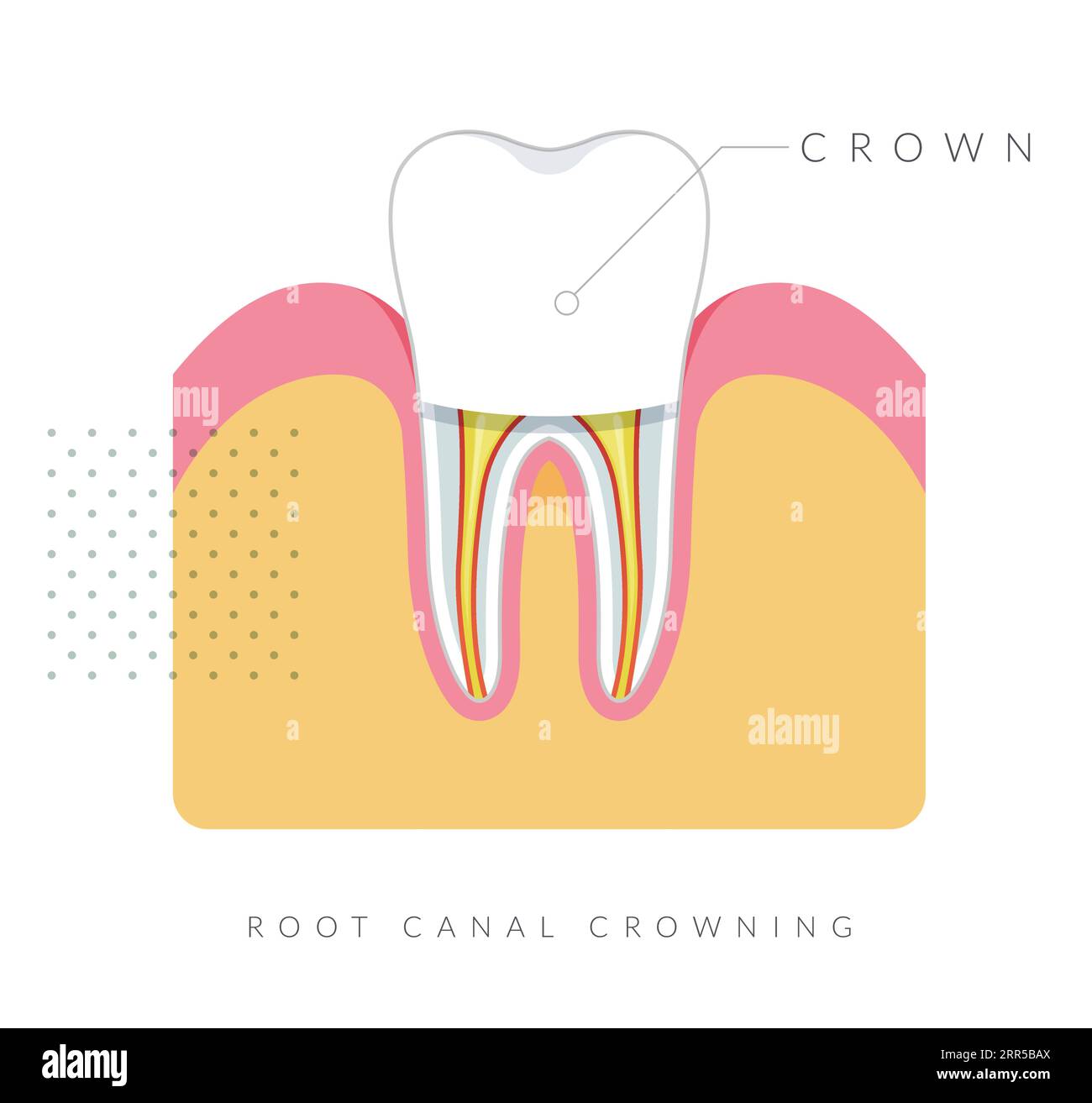 Dental Procedure Root Canal Treatment Stock Illustration as EPS 10