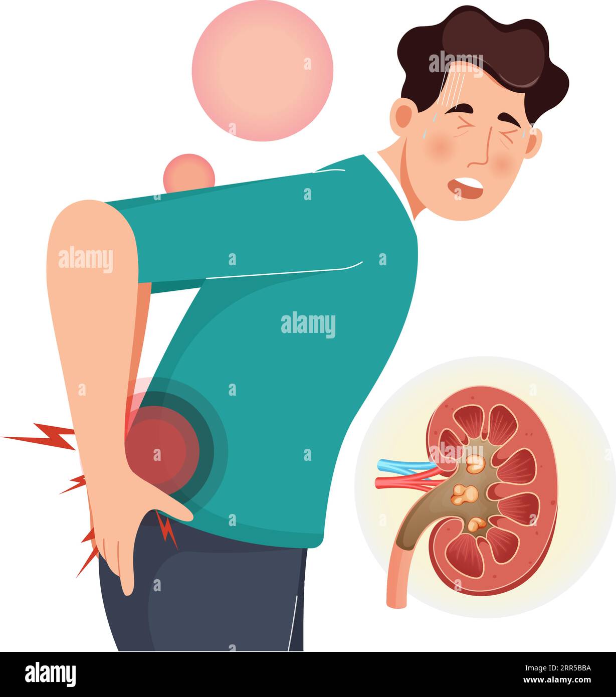 Kidney Stone Pain - Back Pain - Stock Illustration as EPS 10 File Stock ...