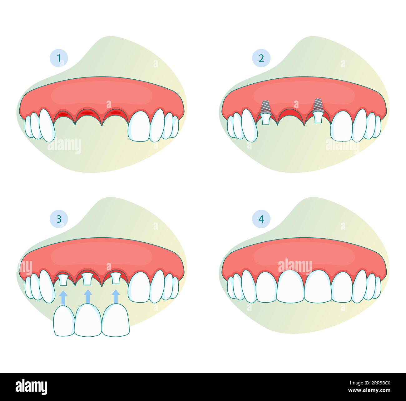 Orthodontics and Tooth Implant Bridge Missing Tooth Dental Care