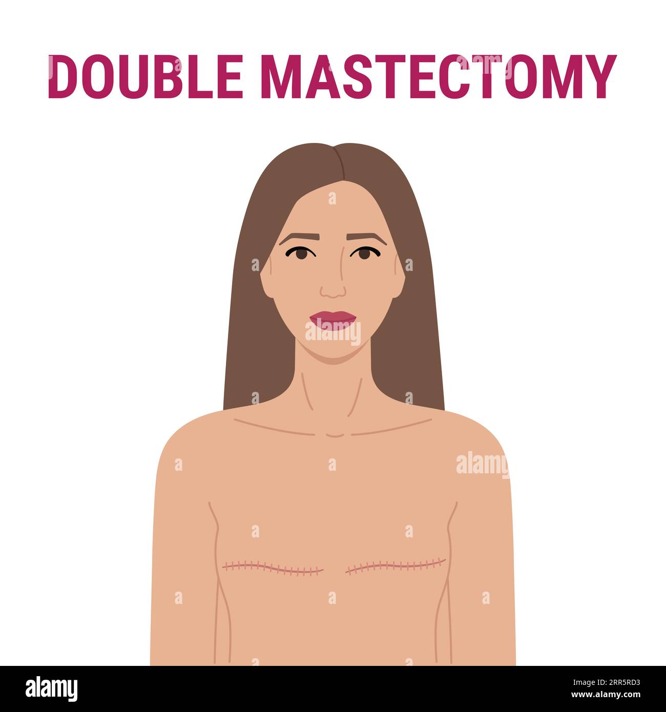 Breast removal surgery double mastectomy. Medical illustration of