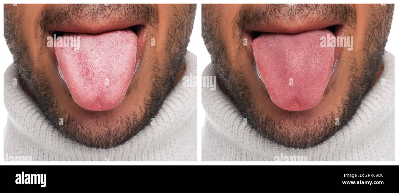 Collage with photos of man before and after tongue cleaning, closeup