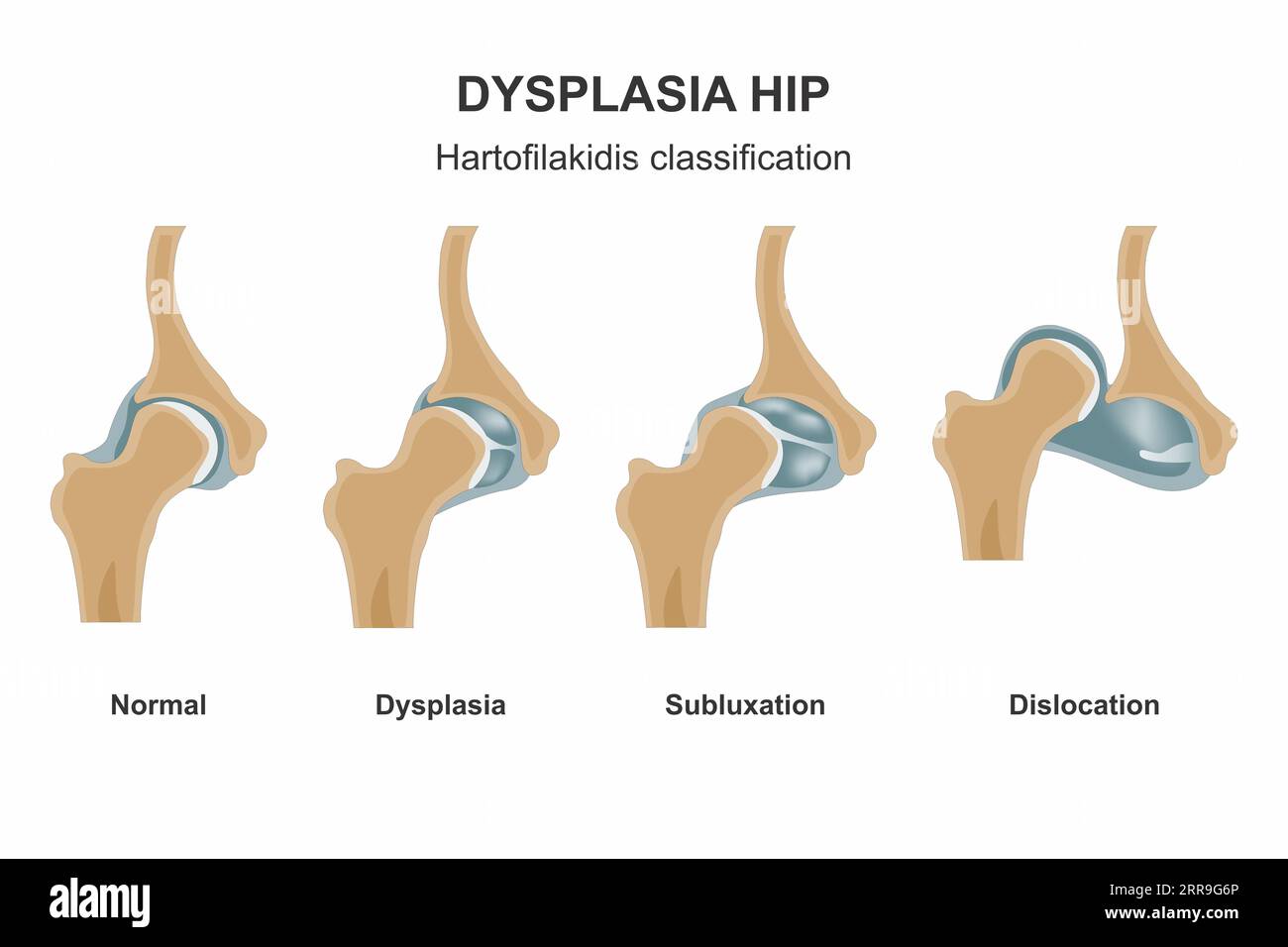 Hip Dysplasia Hi res Stock Photography And Images Alamy