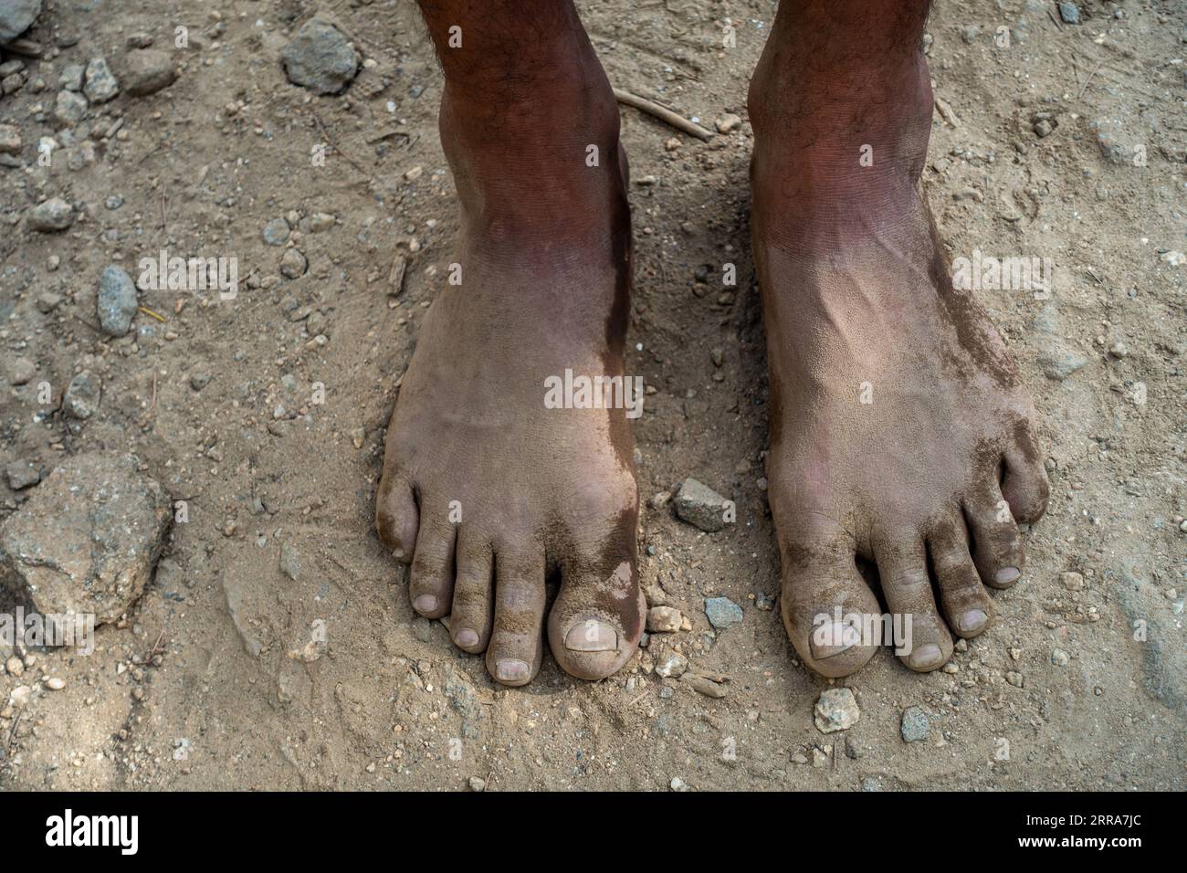 Close-up of Indian male feet, immersed in mud and soil for natural organic therapy, practicing barefoot walking in India. Stock Photo