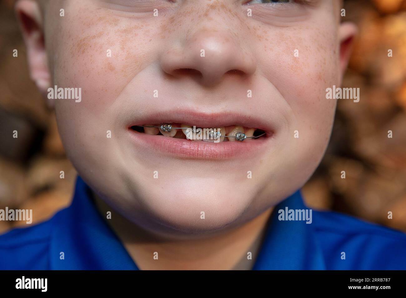 Headgear Braces 2022