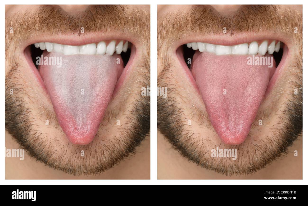 Collage with photos of man before and after tongue cleaning, closeup