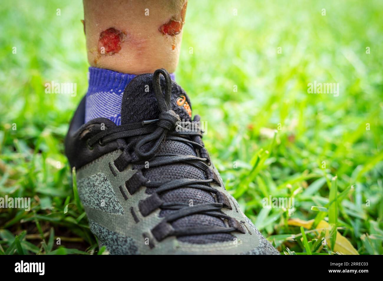 bleeding ankle injuries, Majorca, Balearic Islands, Spain. Stock Photo