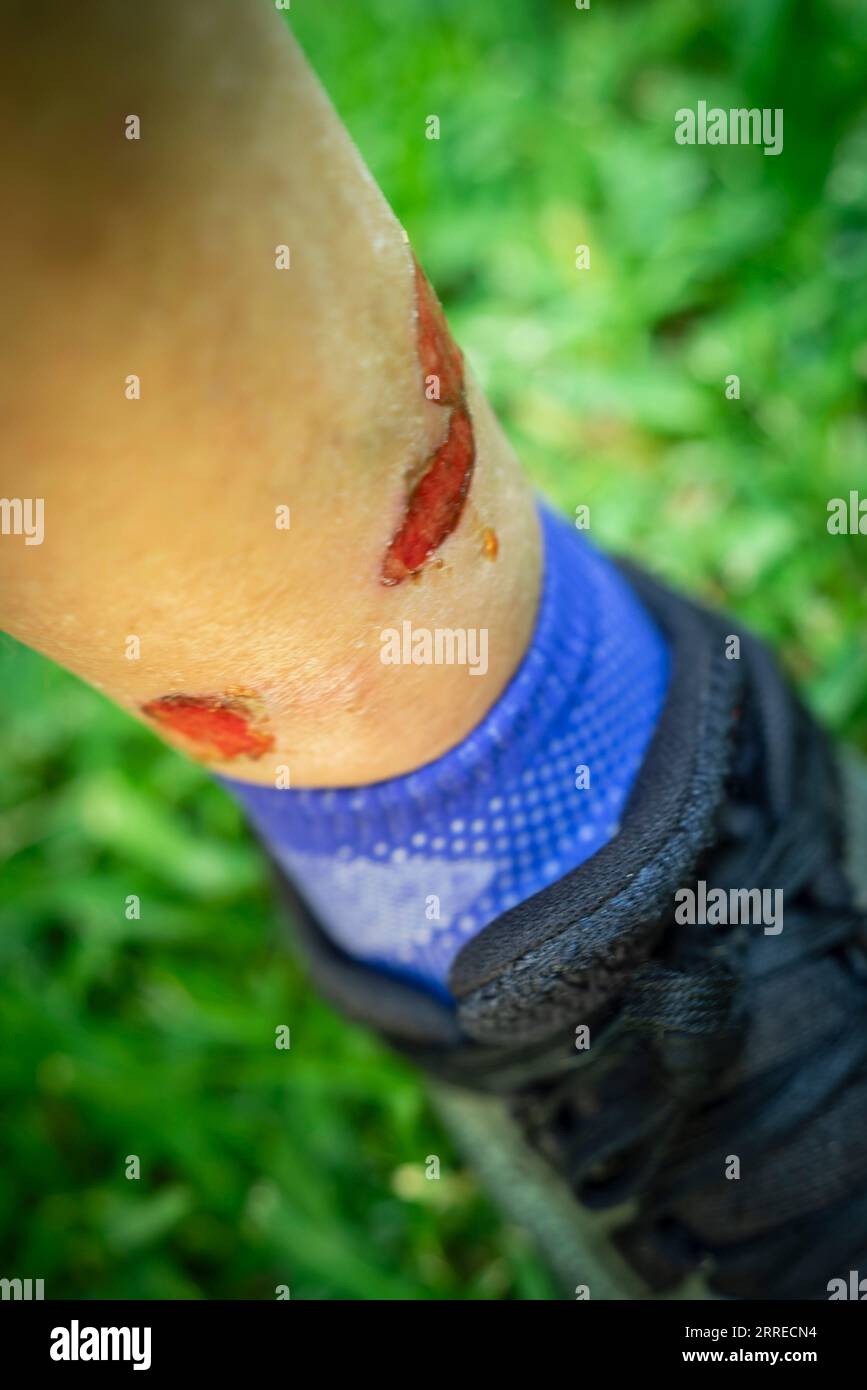 bleeding ankle injuries, Majorca, Balearic Islands, Spain. Stock Photo
