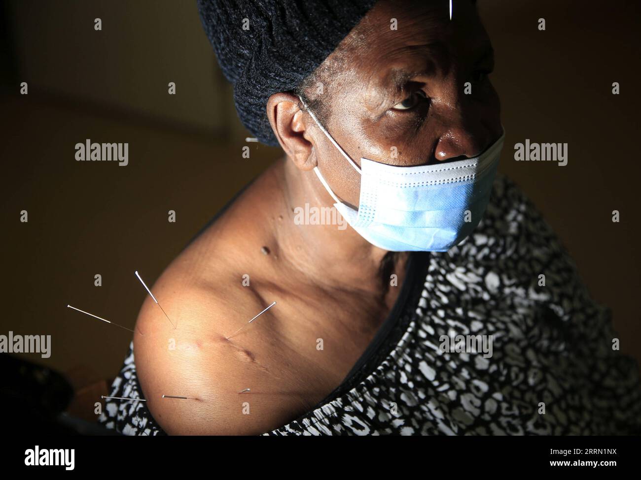 221128 -- HARARE, Nov. 28, 2022 -- A woman receives acupuncture