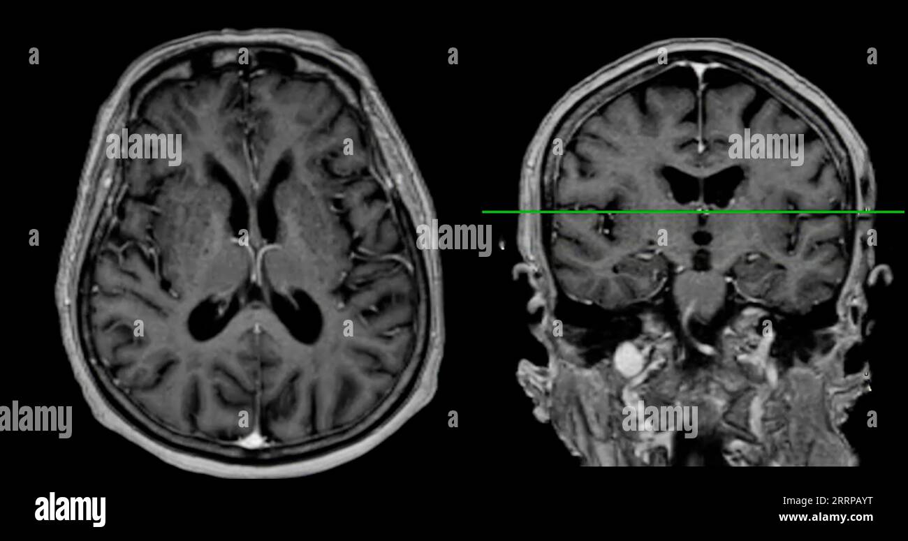 MRI brain scan Axial and coronal view with reference line for detect