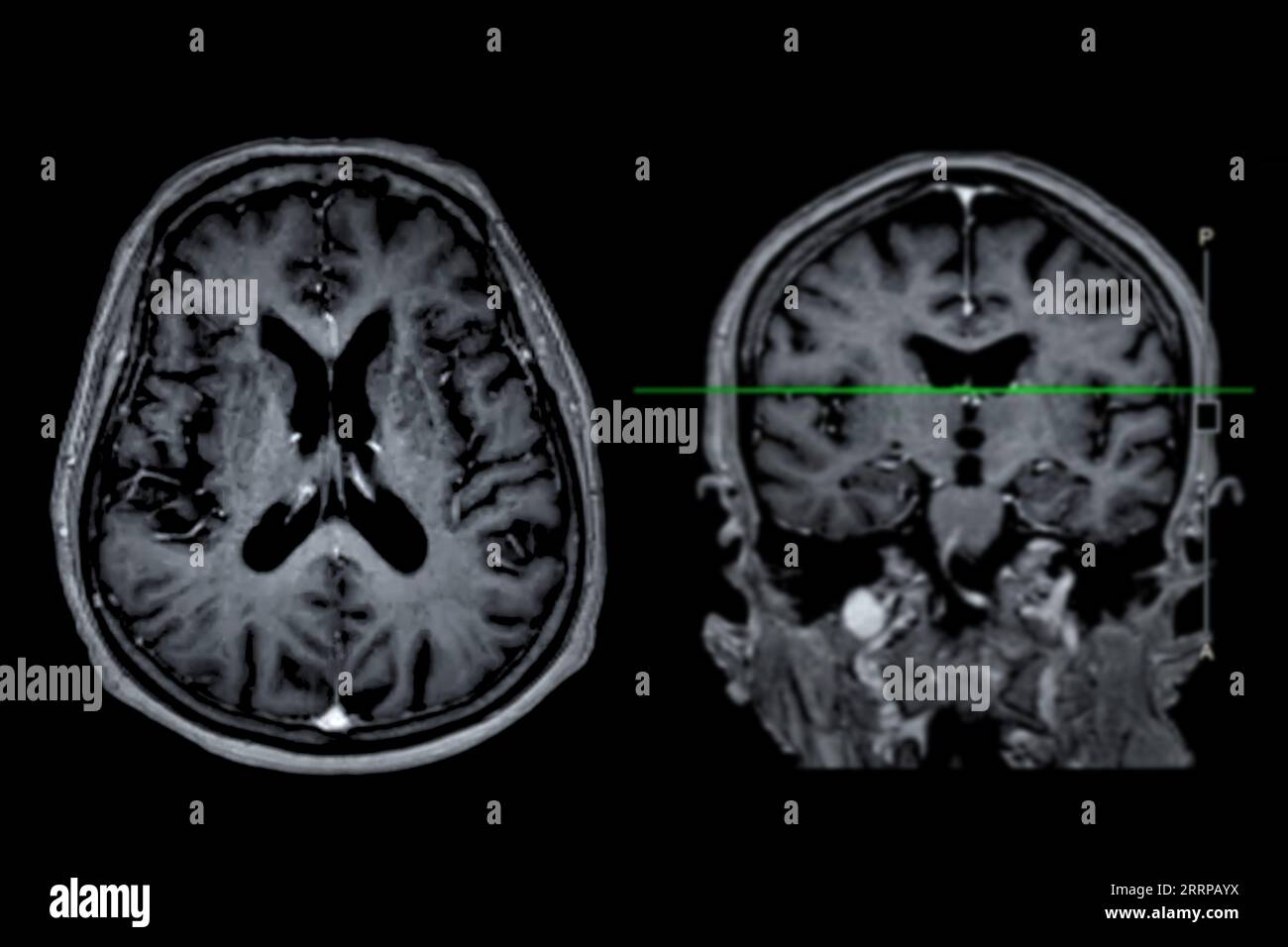 MRI brain scan Axial and coronal view with reference line for detect