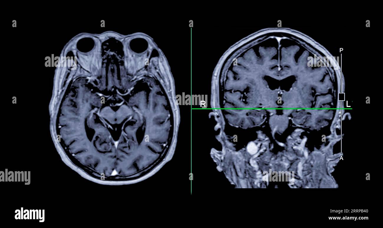 MRI brain scan Axial and coronal view with reference line for detect