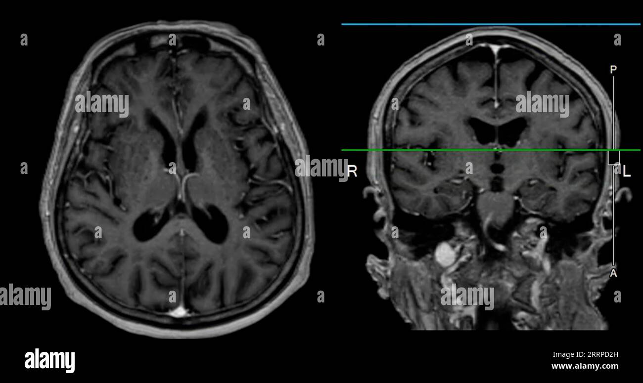 MRI brain scan for detect Brain diseases sush as stroke disease, Brain