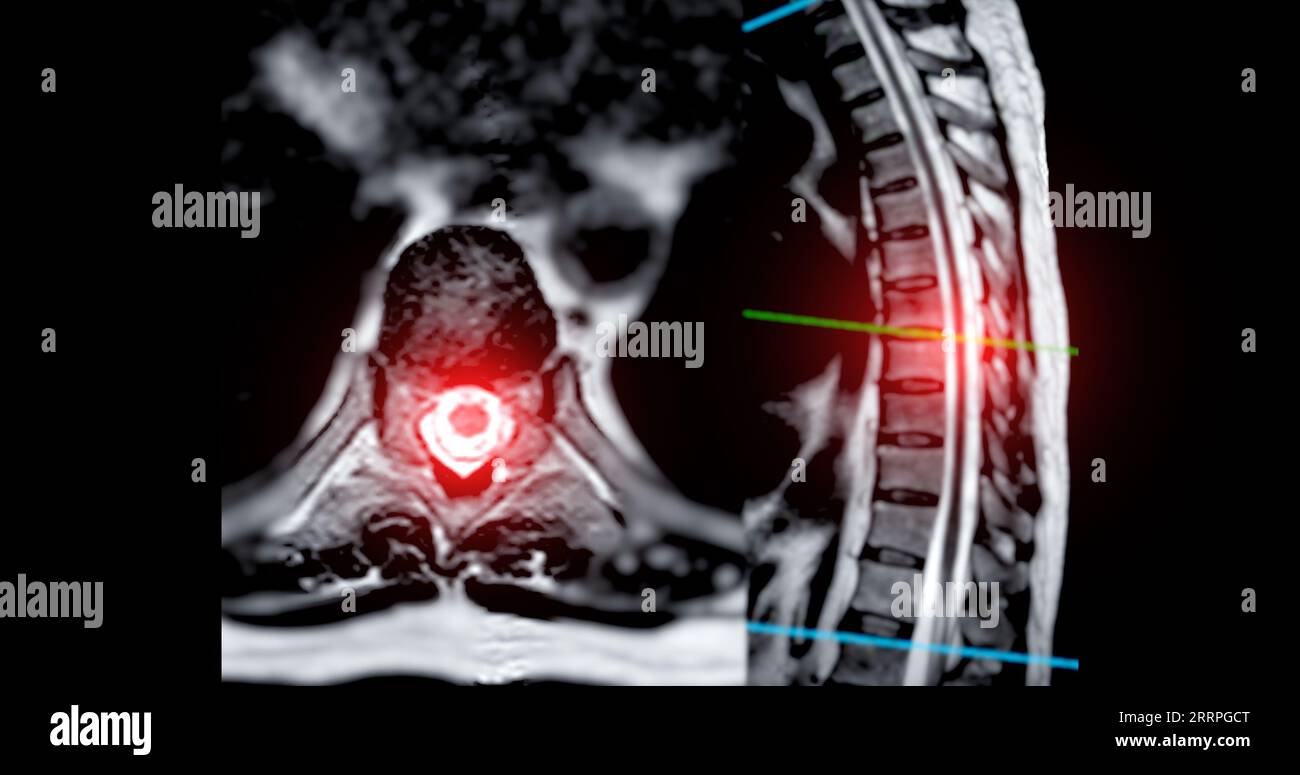 MRI TL spine or Thoracosacral spine Axial and sagittal T2 technique