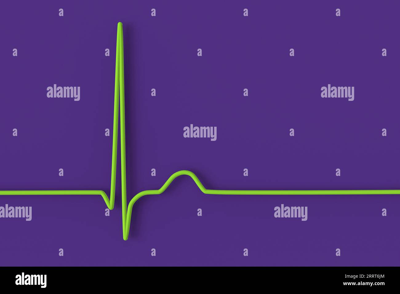 Junctional Rhythm Of The Heartbeat Illustration Stock Photo Alamy junctional-rhythm-of-the-heartbeat-illustration-stock-photo-alamy