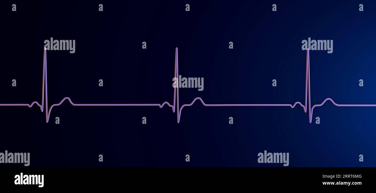 bradycardia gabapentin
