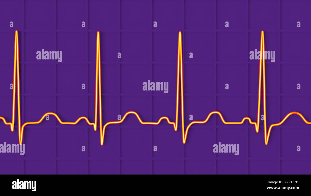 Sinus tachycardia heartbeat rhythm, illustration Stock Photo Alamy