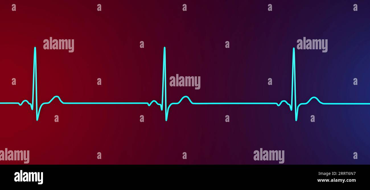 Illustration of an electrocardiogram (ECG) showing sinus bradycardia