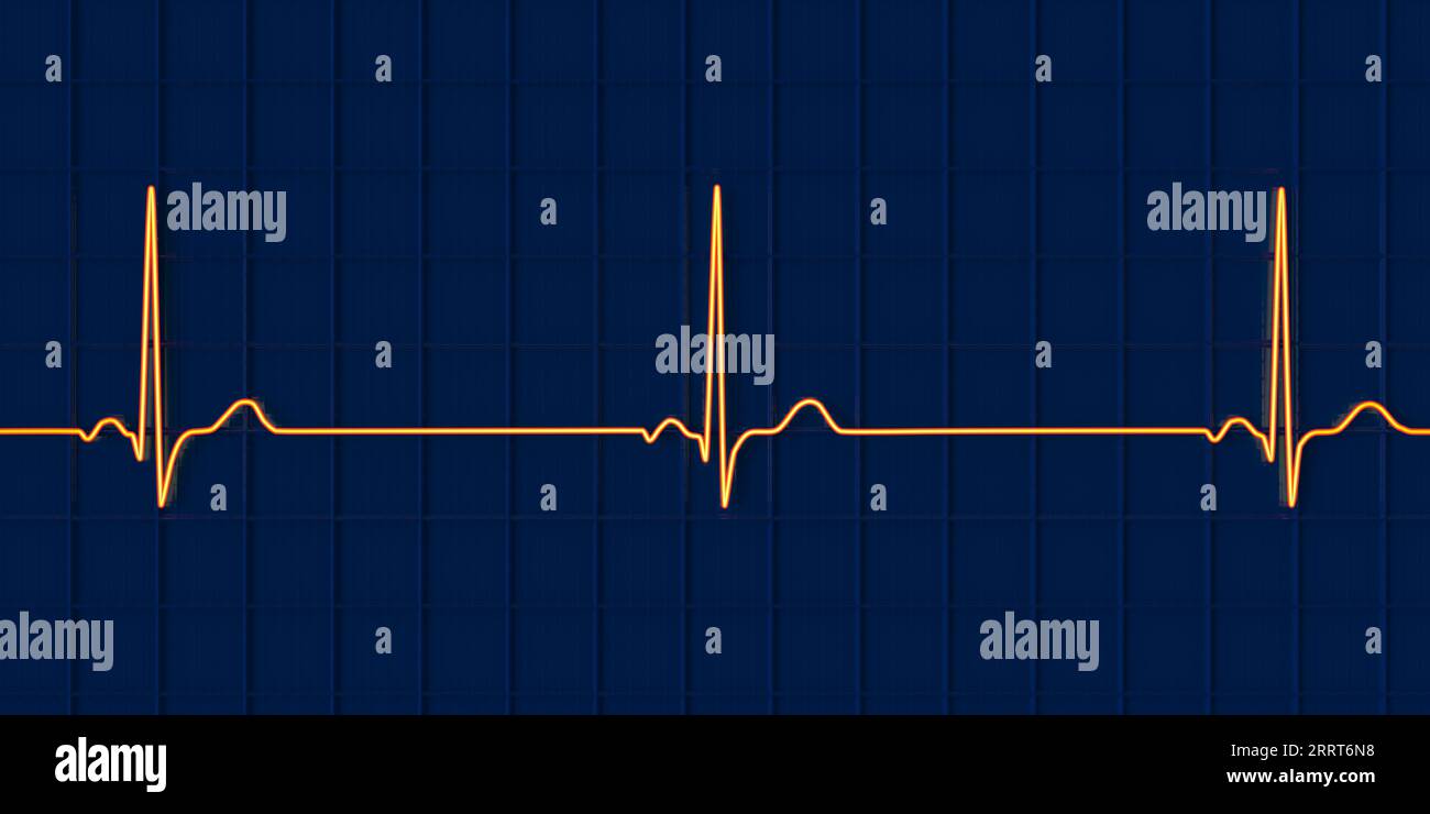 Illustration of an electrocardiogram (ECG) showing sinus bradycardia