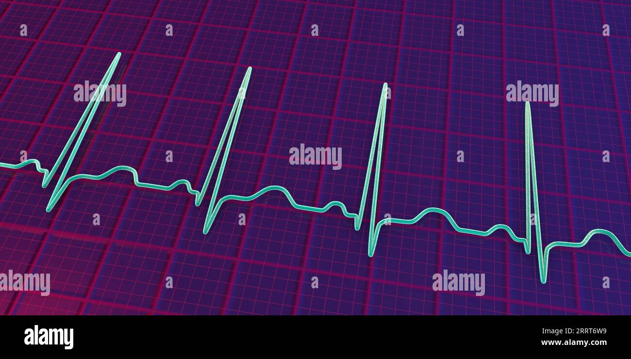 Sinus tachycardia heartbeat rhythm, illustration Stock Photo Alamy