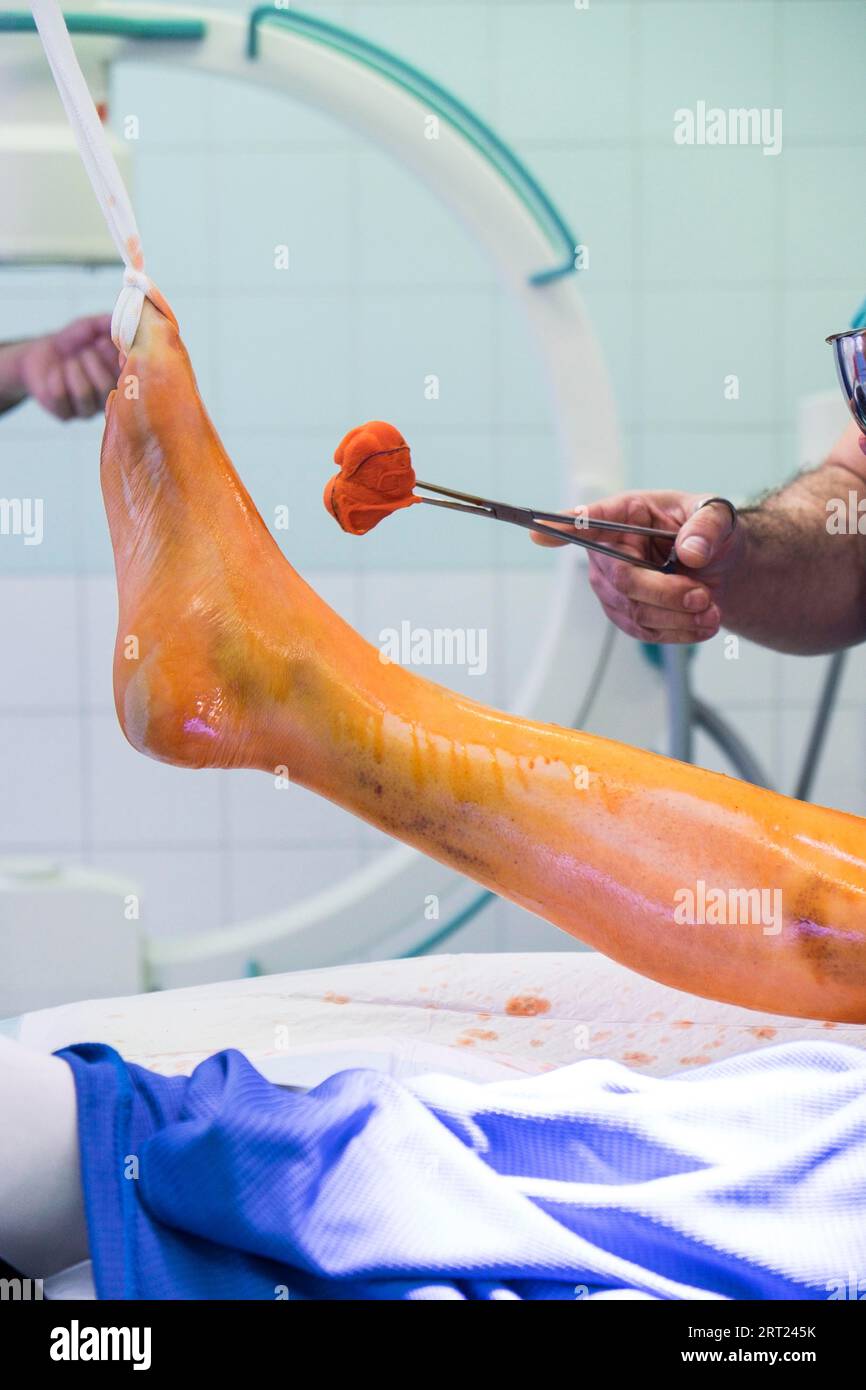 Rubbing one leg with iodine in front of an operation, Duesseldorf, Germany Stock Photo