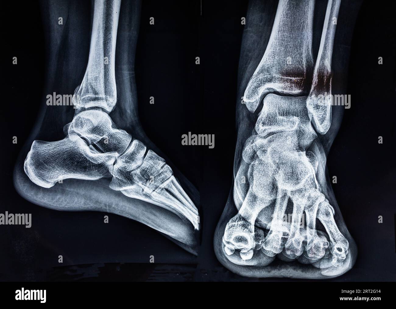 X-ray image of a human female ankle fracture Stock Photo