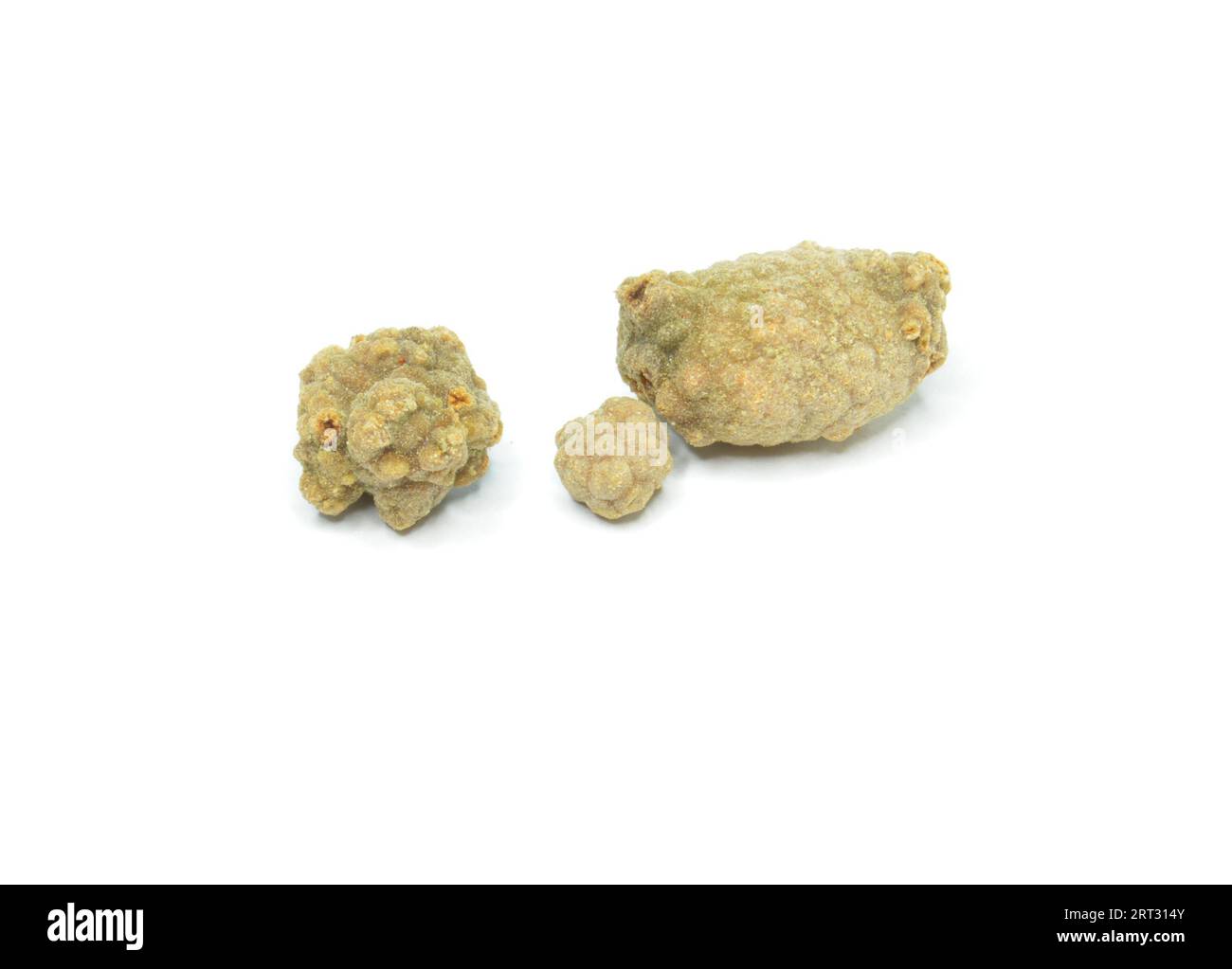 Gallstones small stones, usually made of cholesterol, that form in