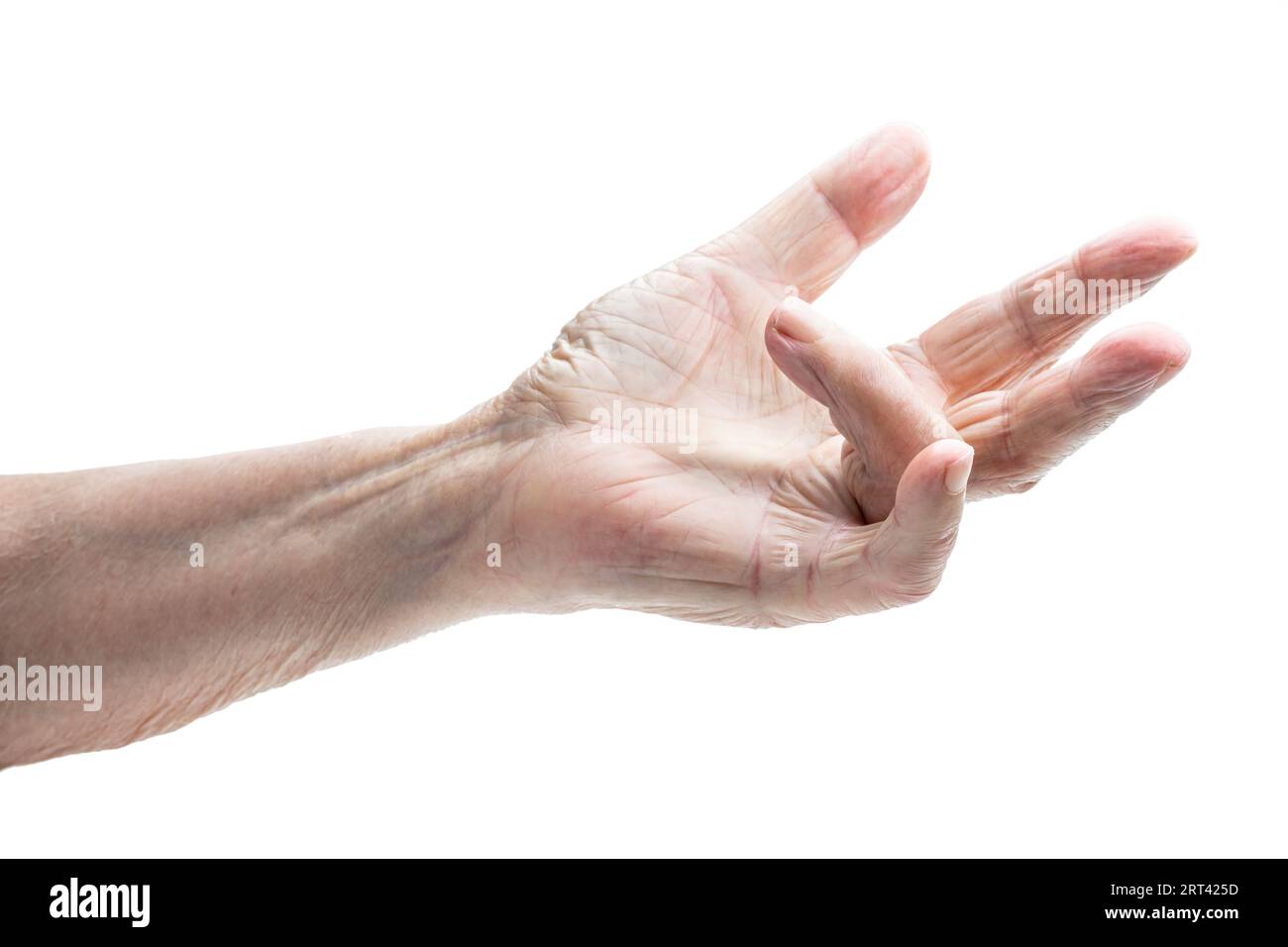 Hand  of an old woman with Dupuytren's contracture disease Stock Photo