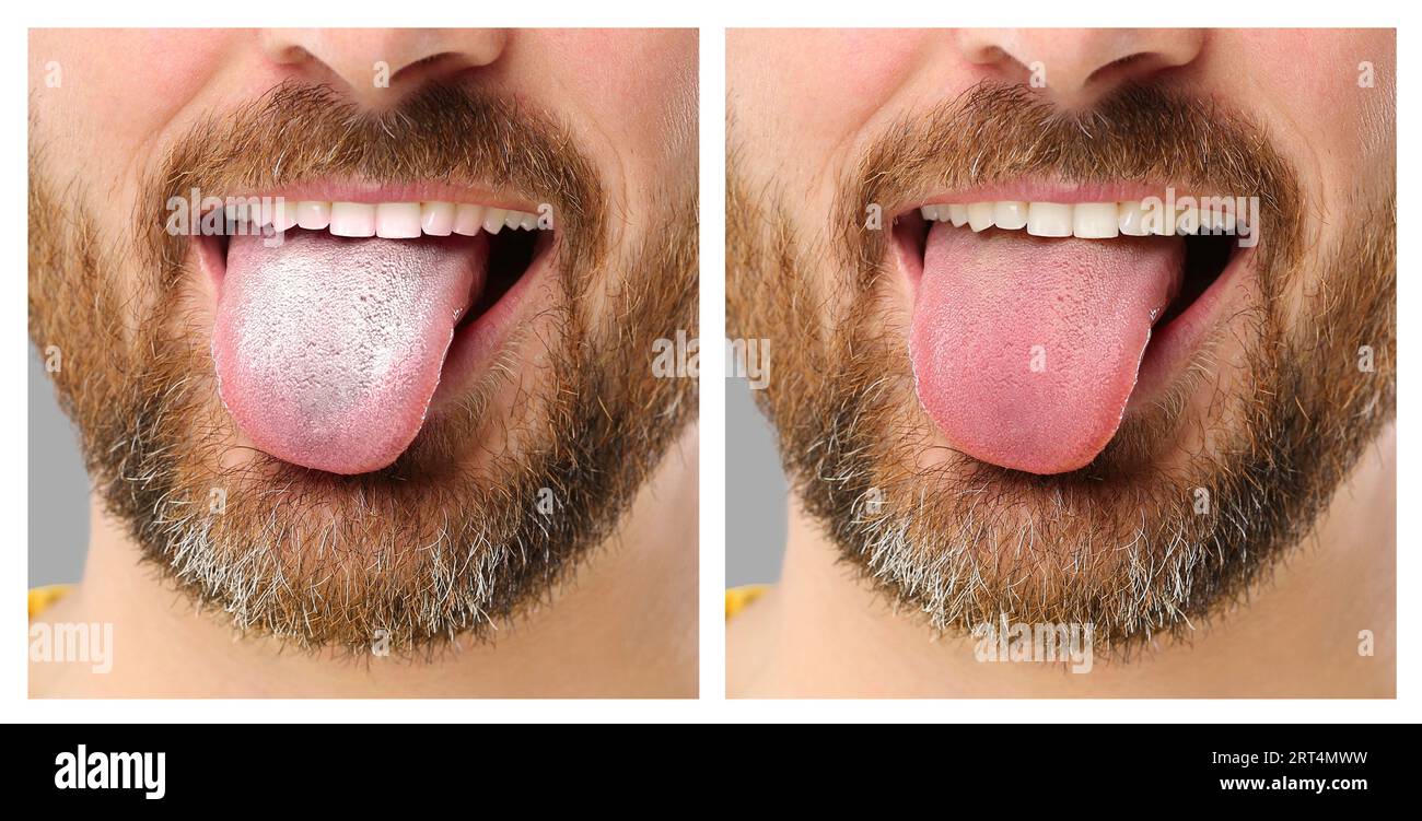 Collage with photos of man before and after tongue cleaning, closeup