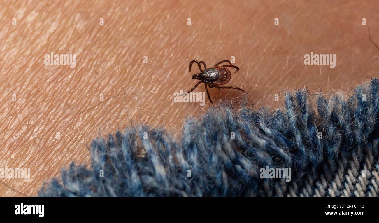 Infected female deer tick on hairy human skin. Ixodes ricinus. Parasitic mite. Acarus. Dangerous biting insect on background of epidermis detail. Disg Stock Photo