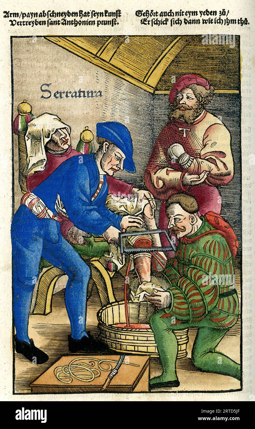 MEDIEVAL LEG AMPUTATION from Feldbuch der Wundartzney published in Strasbourg in 1517 by Hans von Gersdorff Stock Photo