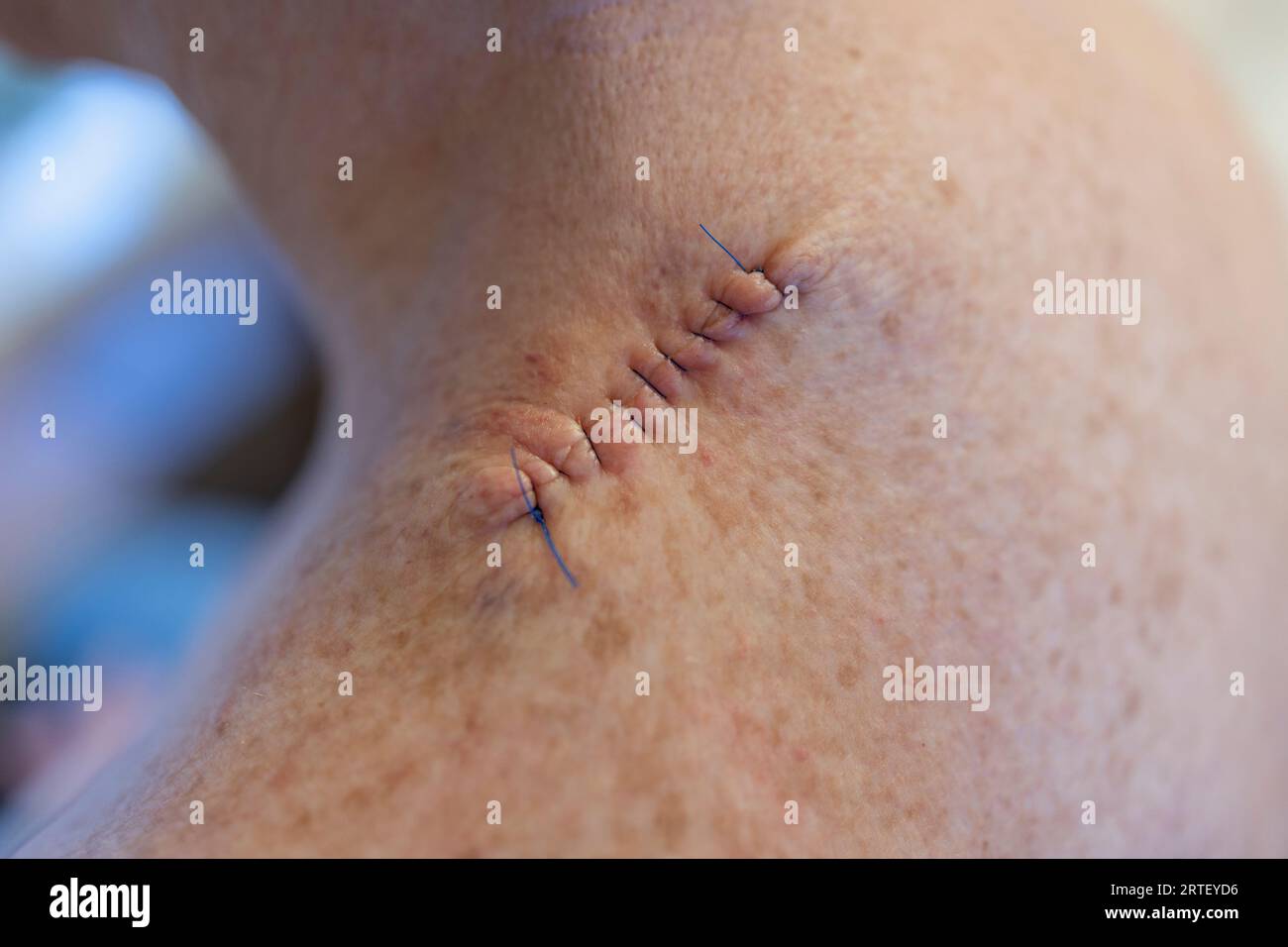 Medical stitches hi-res stock photography and images - Alamy