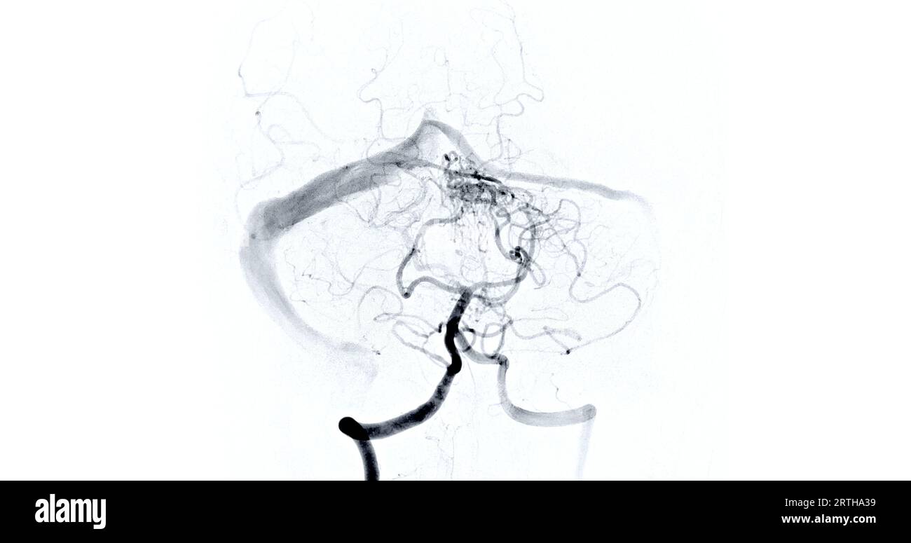 Cerebral angiography image from Fluoroscopy in intervention radiology