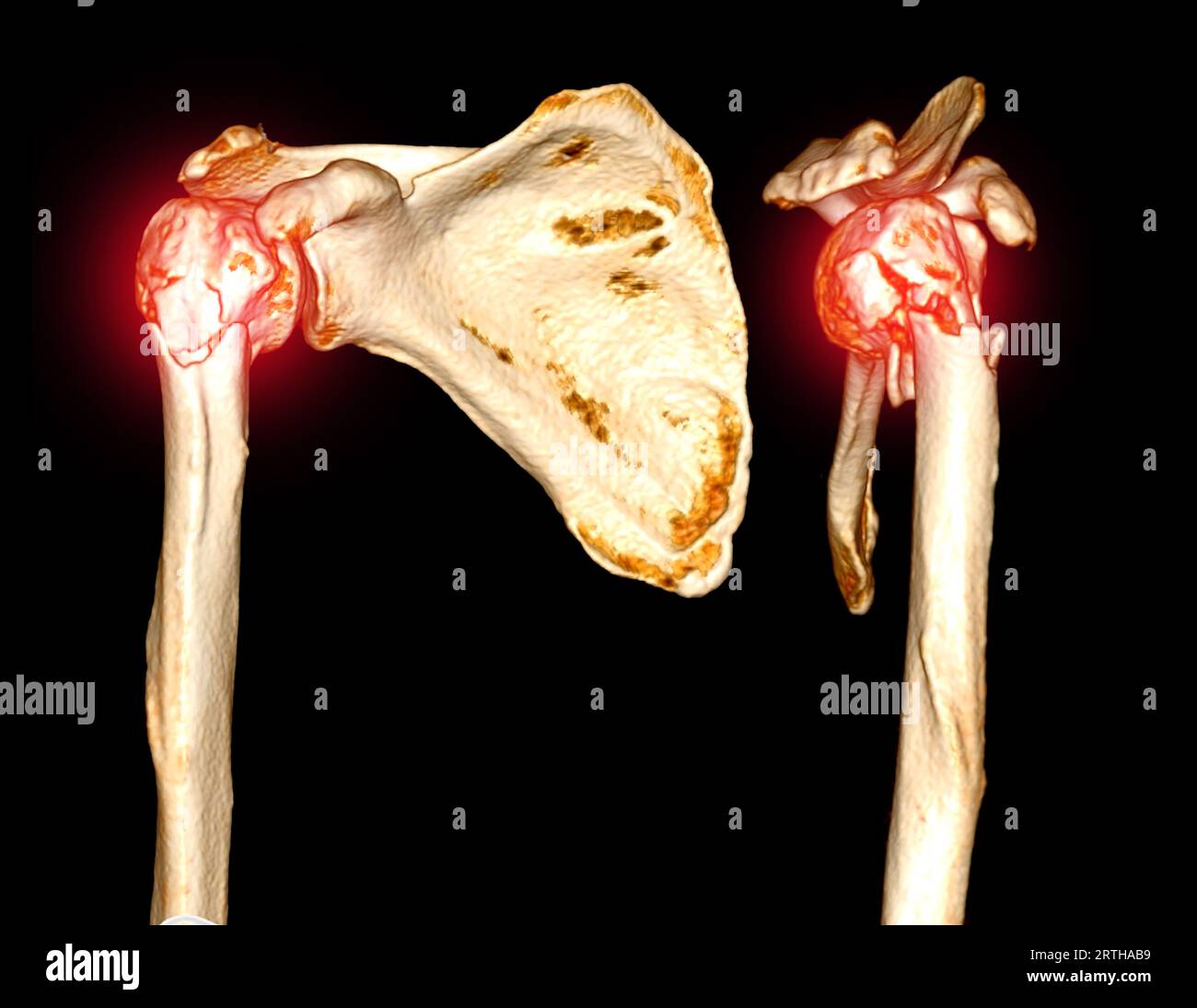 CT scan 3D rendering of shoulder joint showing fracture head of humerus