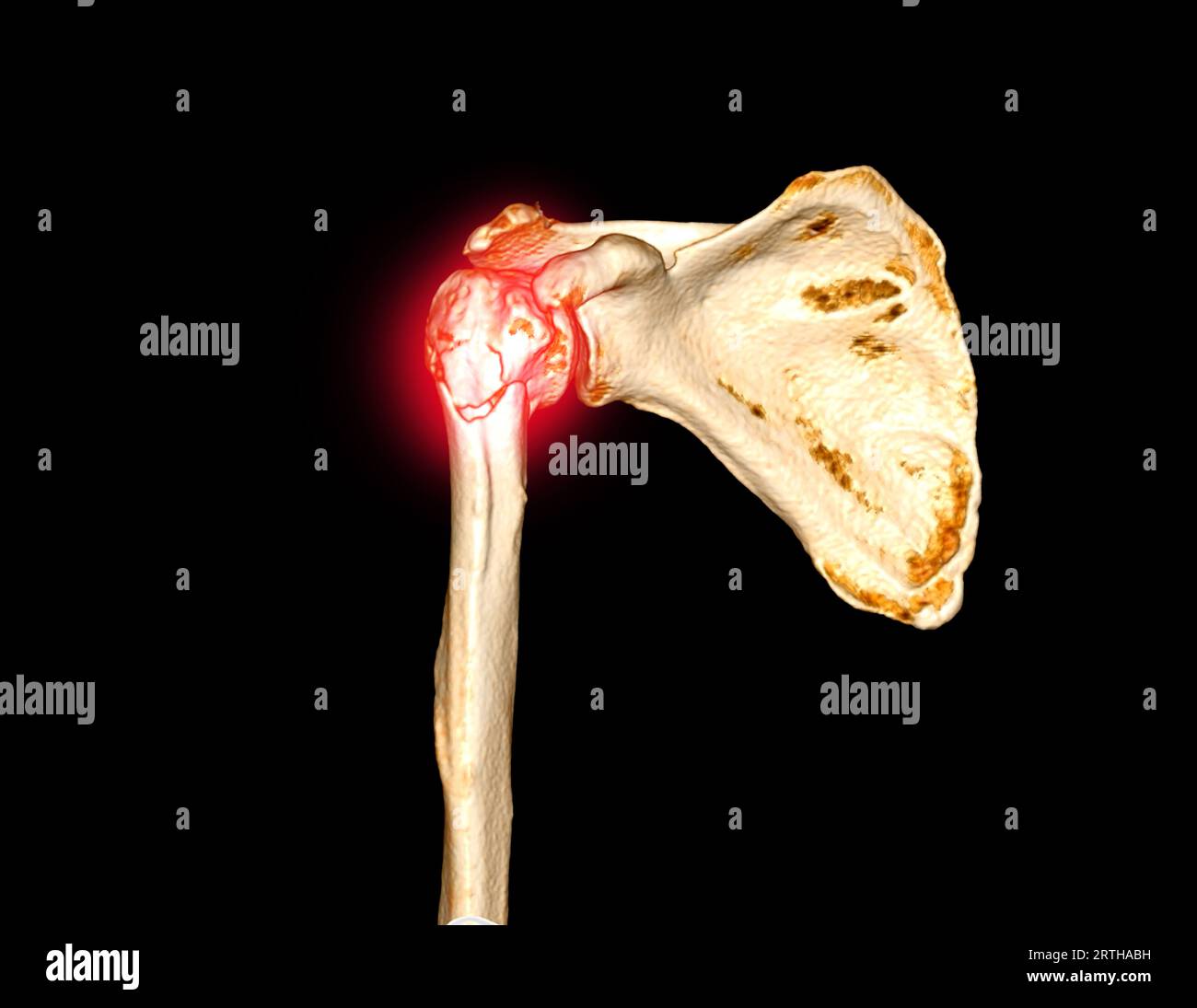CT scan 3D rendering of shoulder joint showing fracture head of humerus