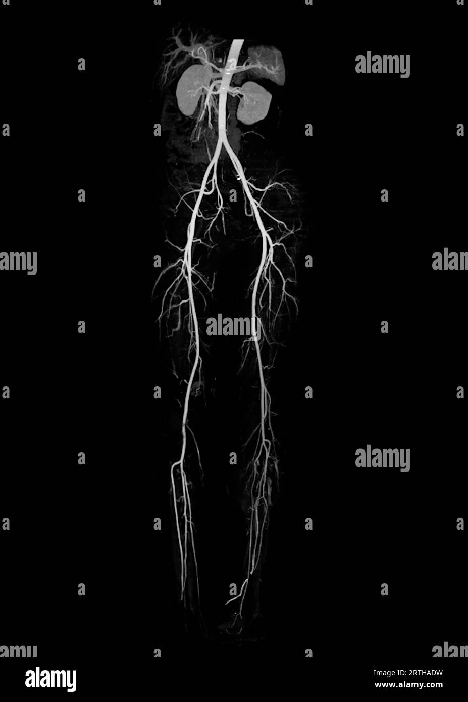 CTA femoral artery run off showing femoral artery for diagnostic Acute