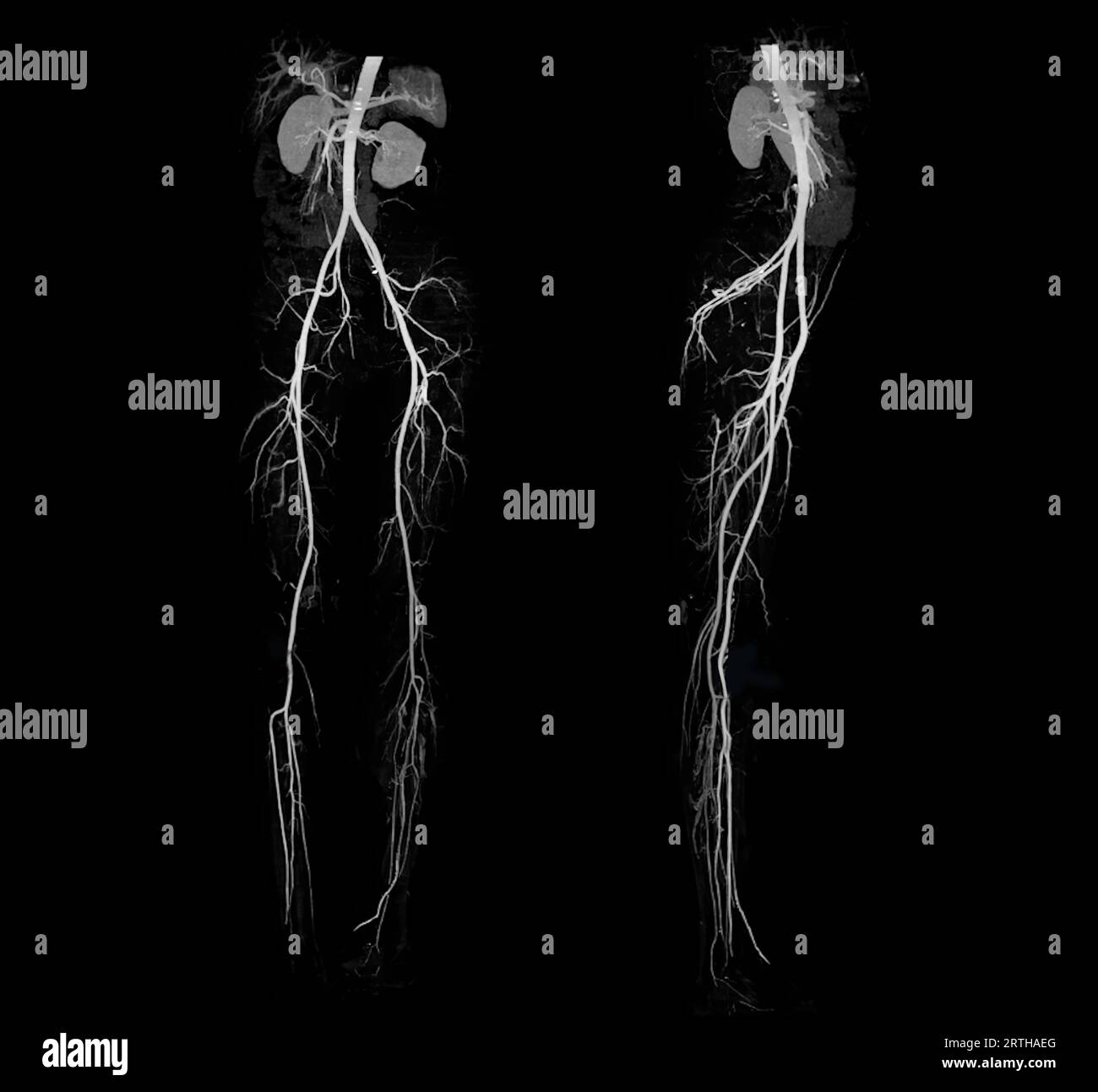 CTA femoral artery run off showing femoral artery for diagnostic Acute ...