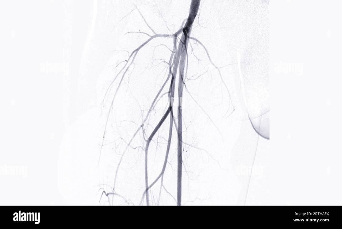 Femoral artery angiogram or angiography Stock Photo