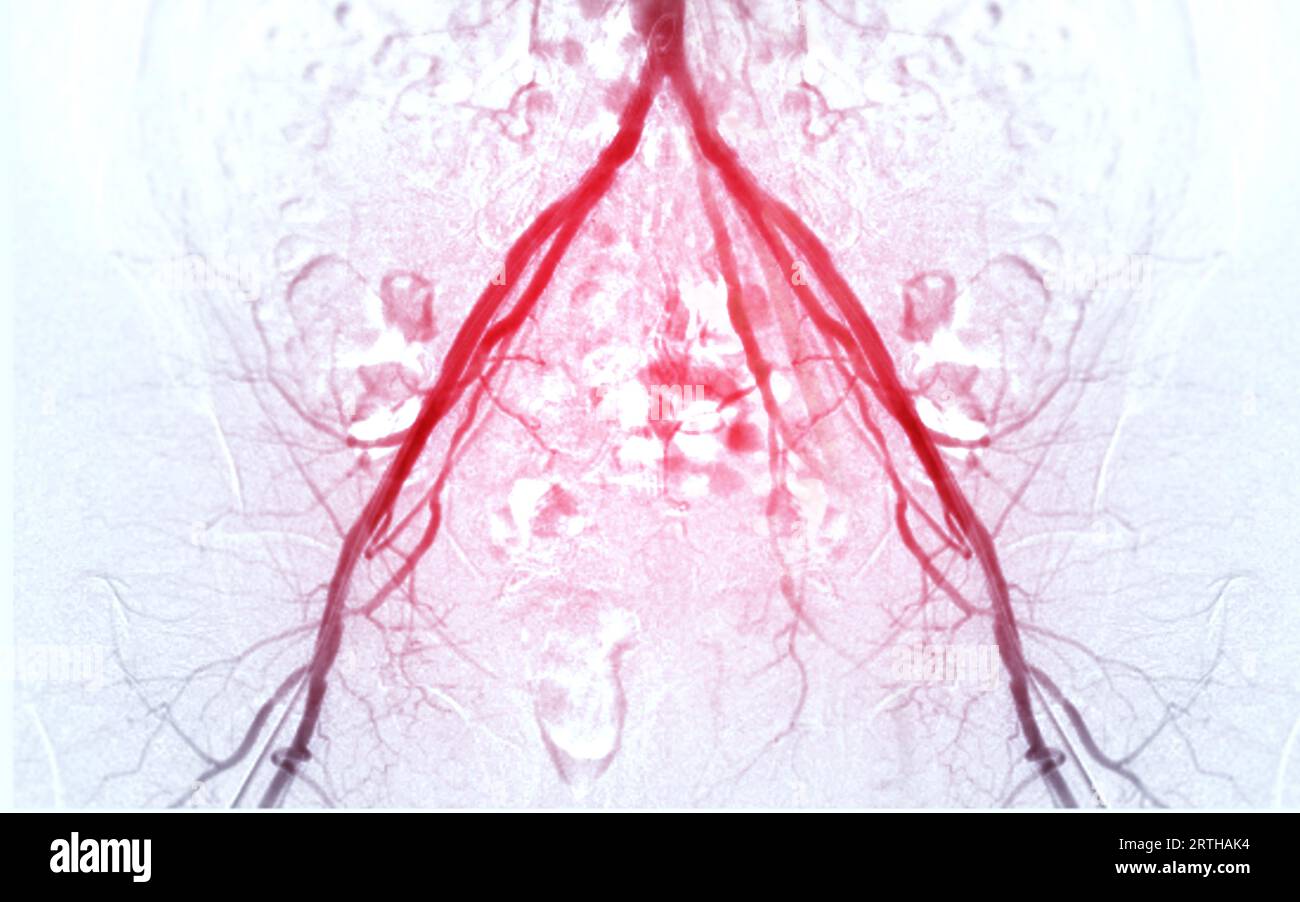 Femoral artery angiogram or angiography Stock Photo