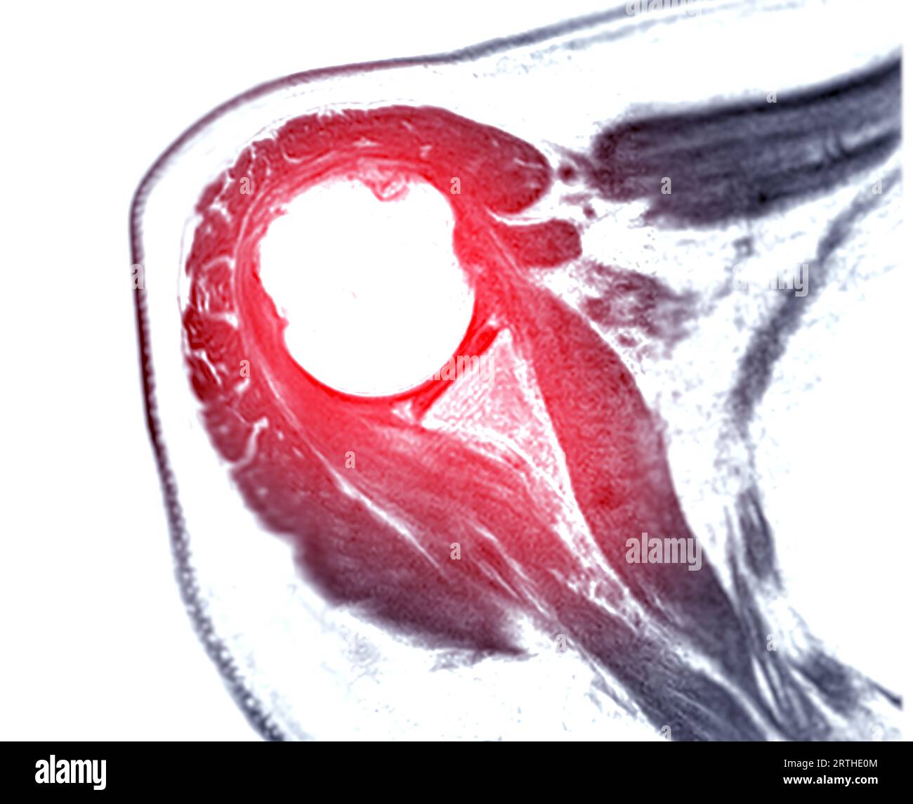 Resonance Imaging or MRI of Shoulder Joint for diagnostic shoulder pain Stock Photo Alamy